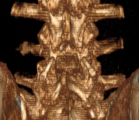 Karma MRI 3D Scan Image showing cortico-pedicular fixation_Spinal Elements